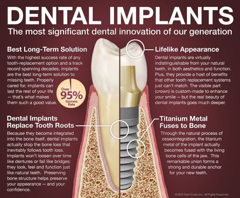 Dental Implants